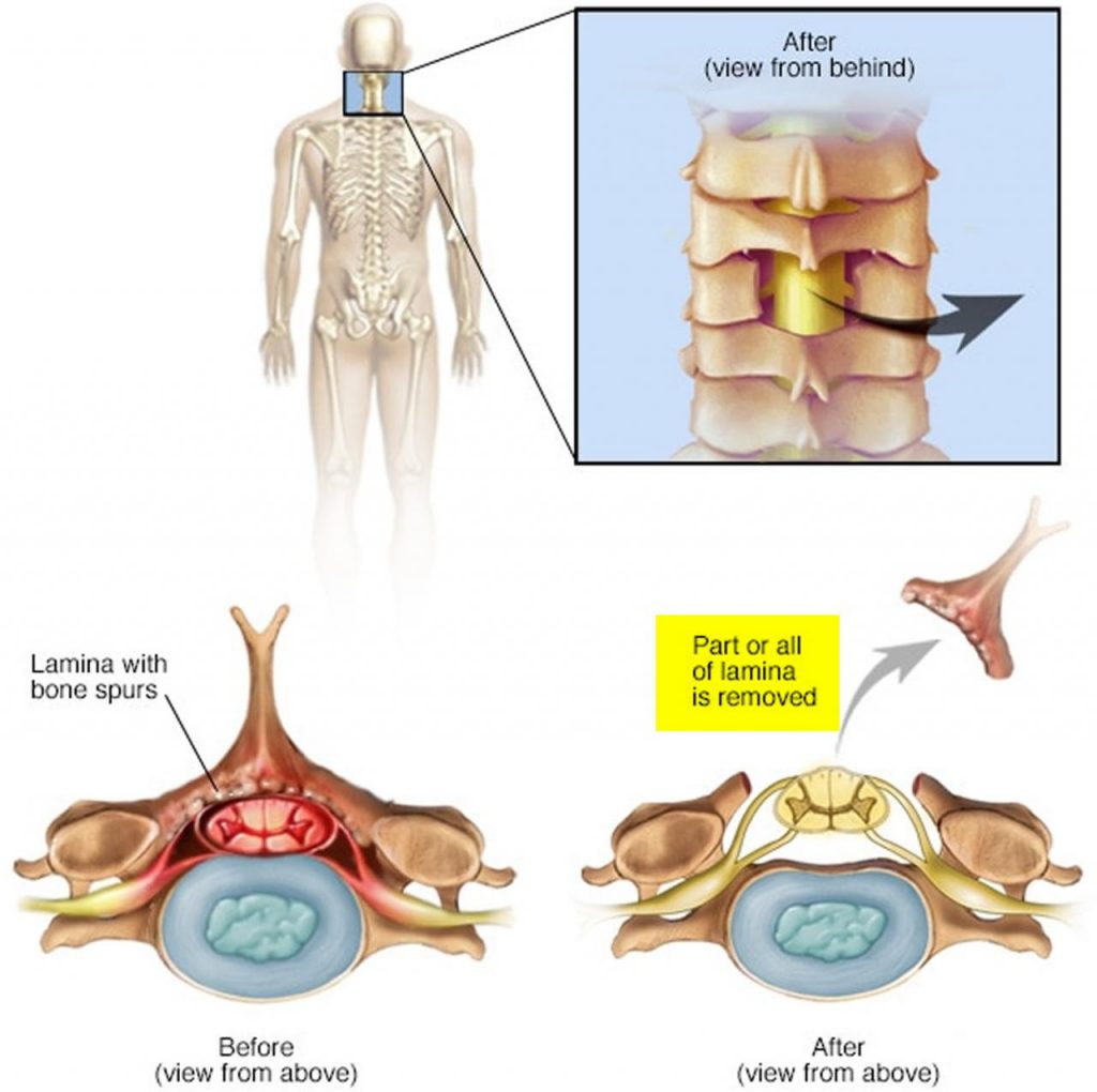 Discovering Relief: What is Laminectomy and How Can it Alleviate Spinal Compression?