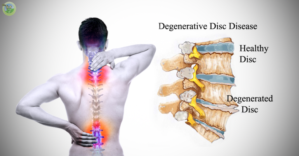 Understanding Degenerative Disc Disease