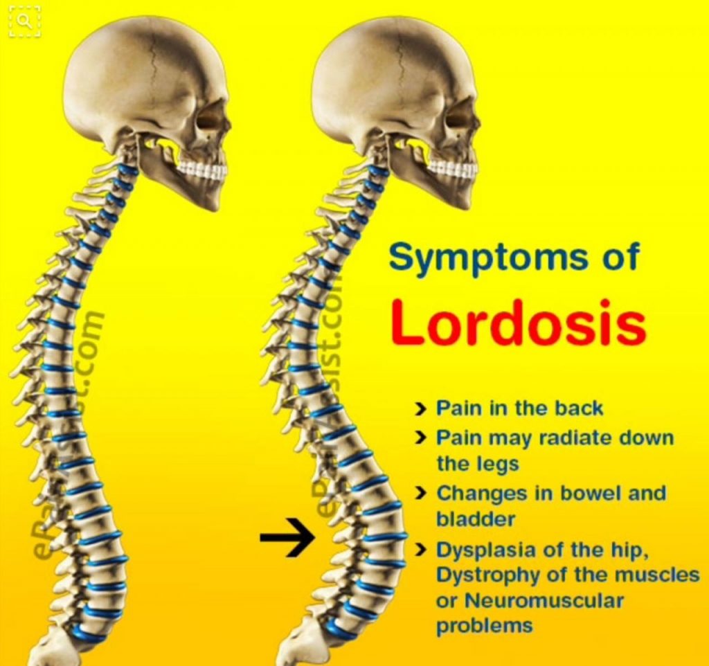 Understanding Lordosis in Children