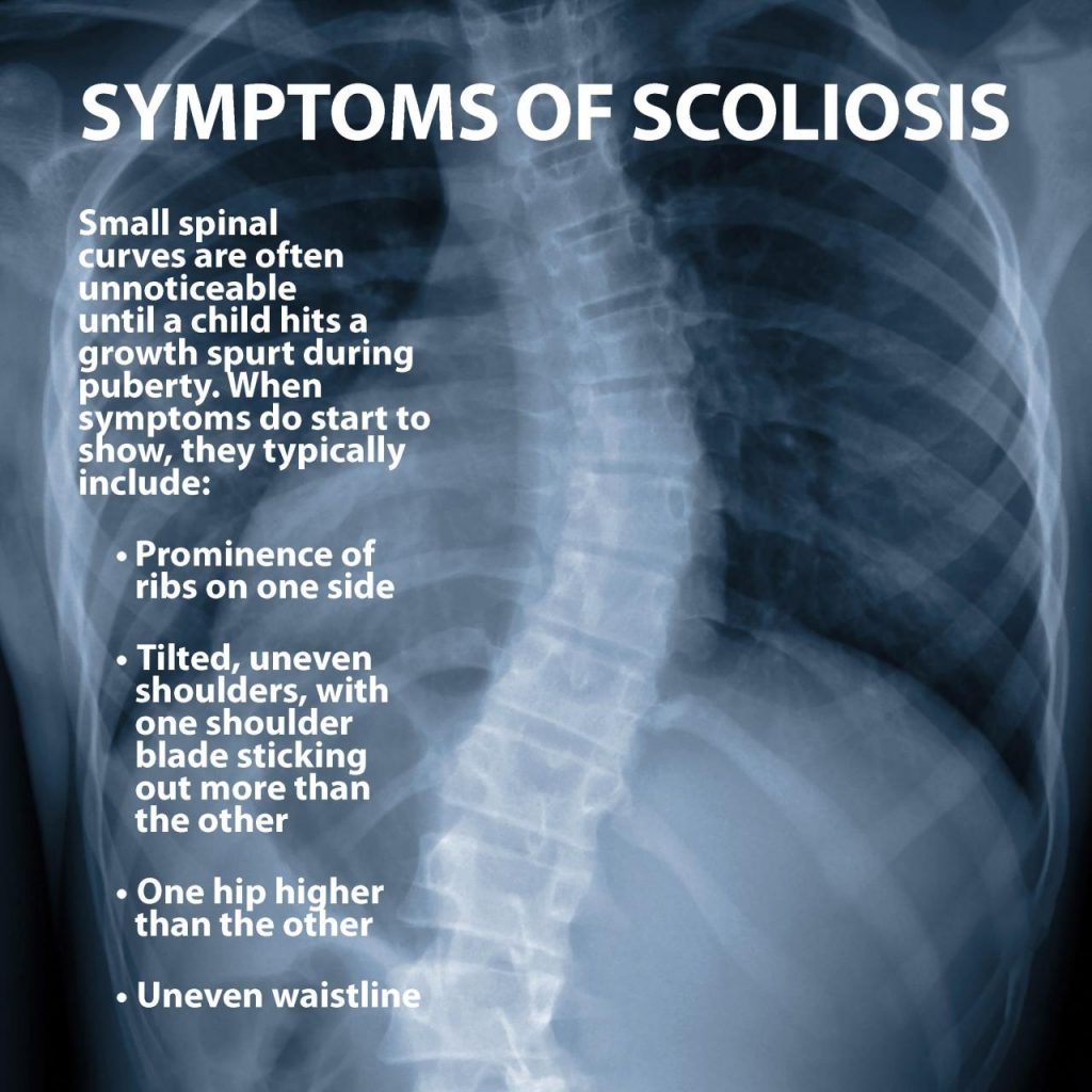 Scoliosis Spine Curvature
