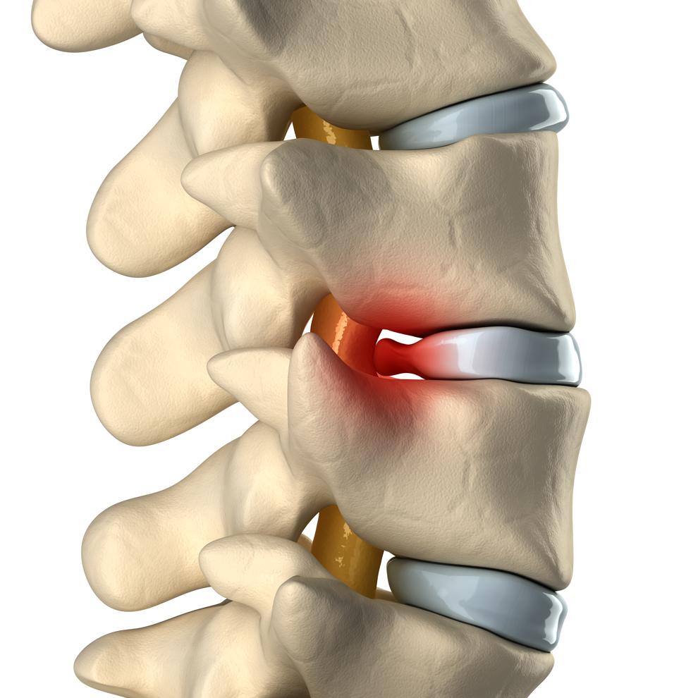 Illustration of a herniated disc