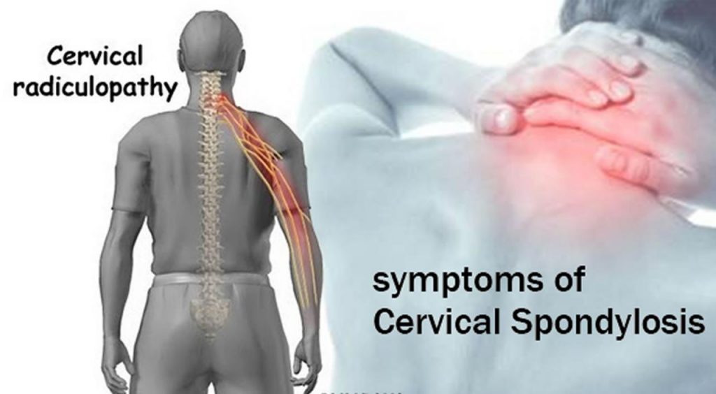 What Causes Cervical Spondylosis and How Can You Recognize the Symptoms?