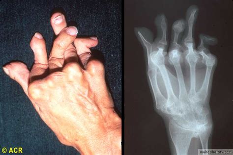 Arthritis Impact on Health