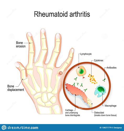 Autoimmune Arthritis