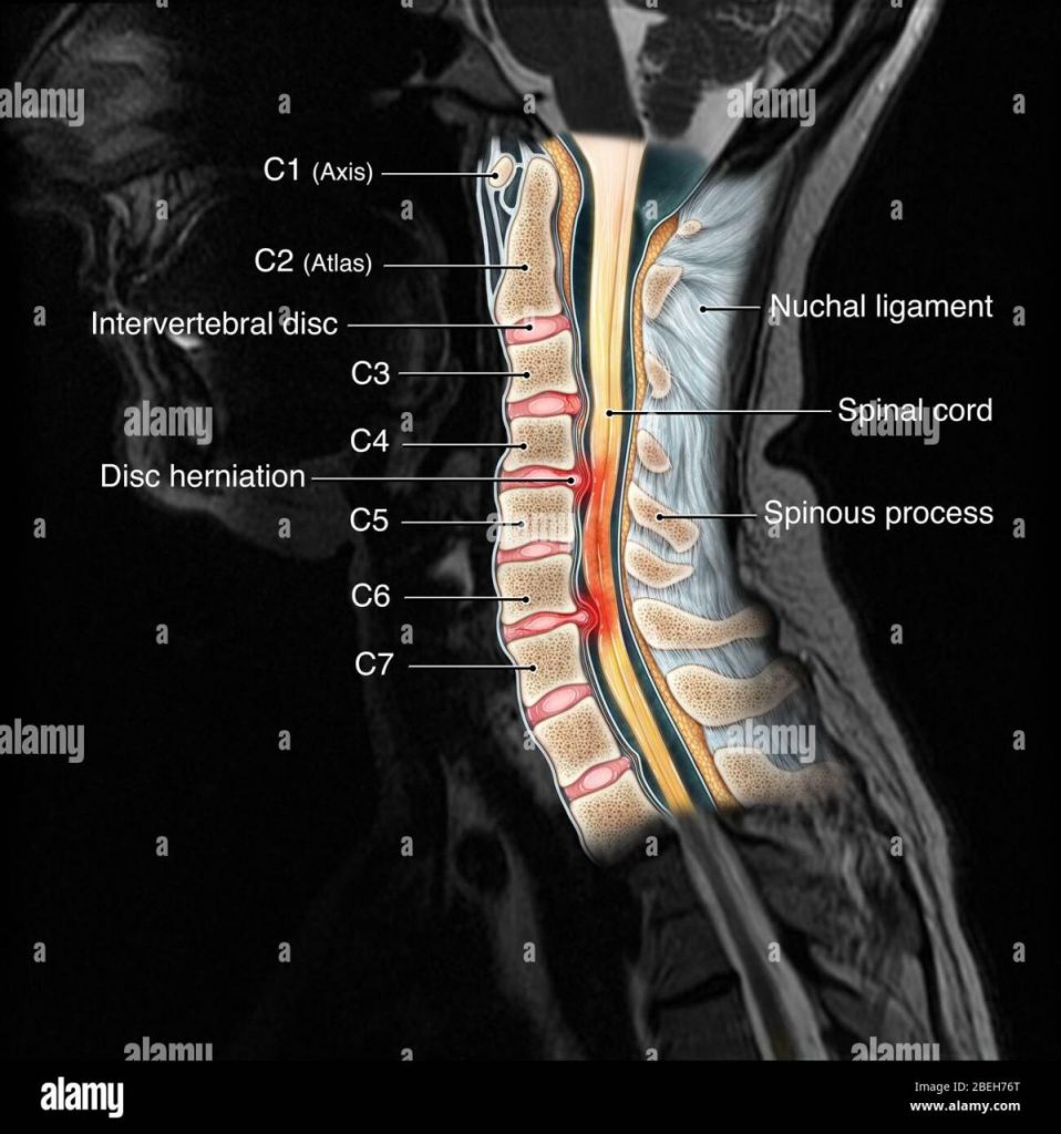 Cervical Spine Injury MRI