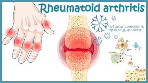 What Diseases Can Be Mistaken for Rheumatoid Arthritis?