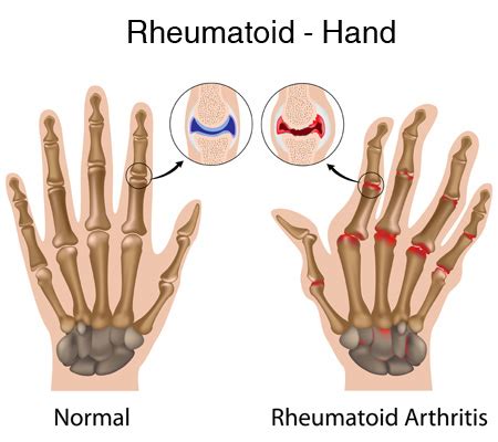 What Is Autoimmune Arthritis? Symptoms, Causes, and Diagnosis