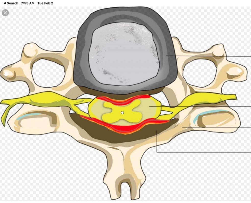 Cervical Stenosis Illustration
