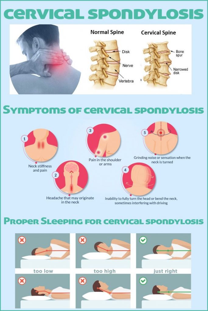 Understanding Cervical Spondylosis
