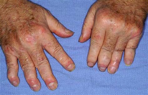 Understanding Different Types of Rheumatoid Arthritis