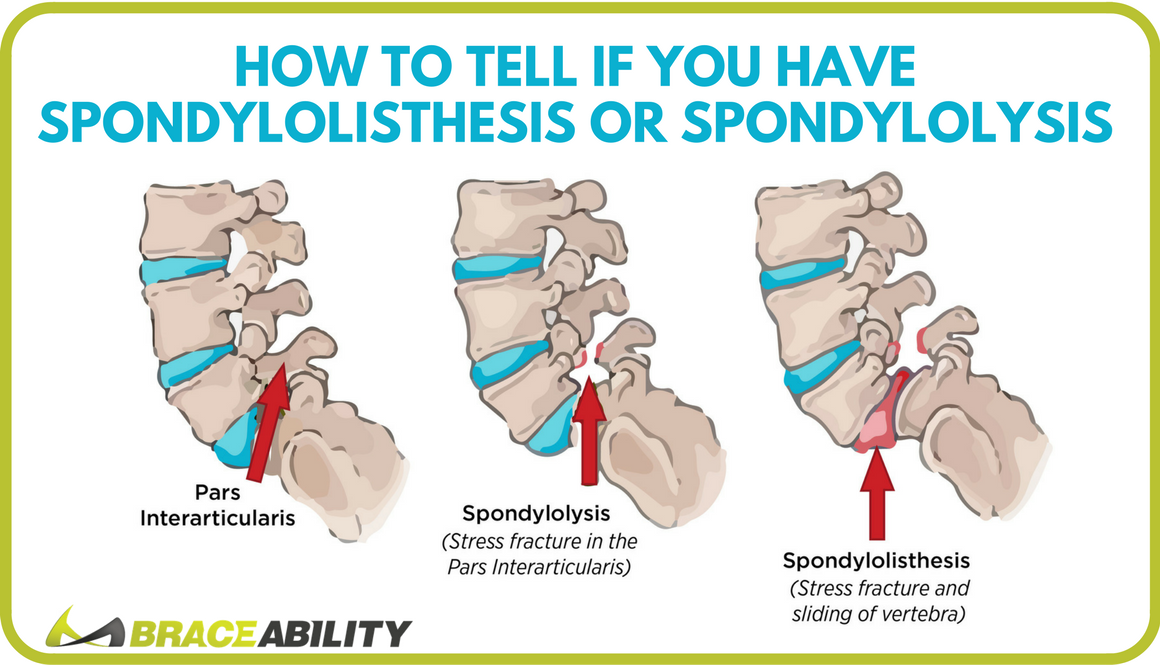 Understanding Lumbar Spondylosis: Causes, Symptoms, and Treatments