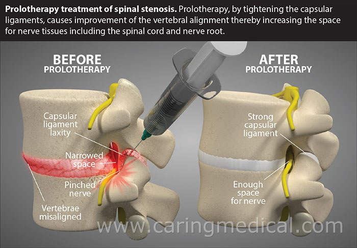 Understanding Treatments for Lumbar Spinal Stenosis: From Therapy to Surgery