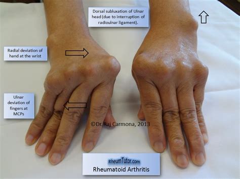 Which Joints Are Most Commonly Affected by Rheumatoid Arthritis?
