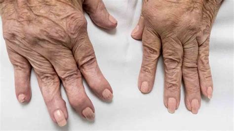 Rheumatoid Arthritis: Symptoms, Causes, and Treatment