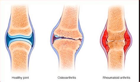 Rheumatoid Arthritis vs. Osteoarthritis: Understanding the Differences