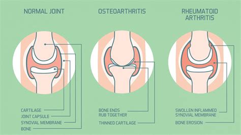 Rheumatoid Arthritis vs. Osteoarthritis Comparison