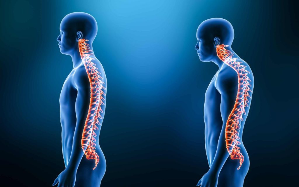 Understanding Kyphosis: Causes, Symptoms, and Treatments