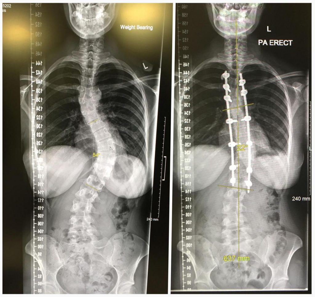 Understanding Posterior Spinal Fusion Surgery: What You Need to Know