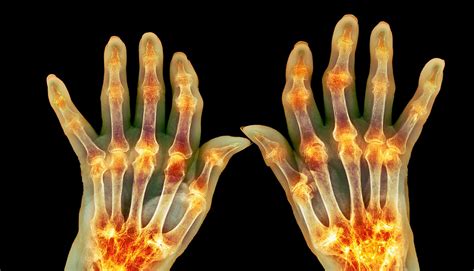 Understanding the Connection Between Rheumatoid Arthritis and Heart Disease