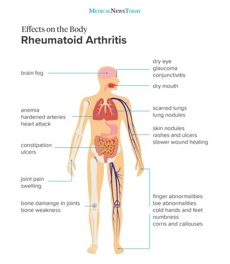 Understanding the Multifaceted Impact of Rheumatoid Arthritis on the Human Body