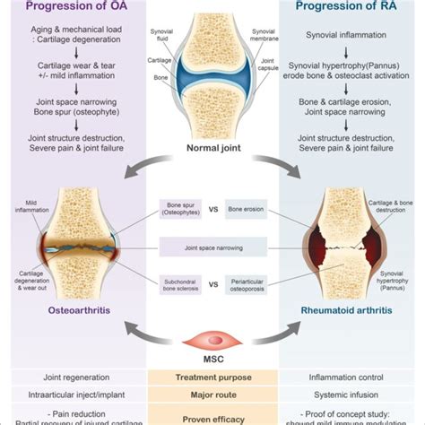 Understanding the Progression of Rheumatoid Arthritis: Key Signs and Stages