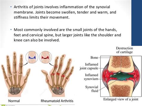 What Joints Are Most Affected by Rheumatoid Arthritis? - Becker Spine