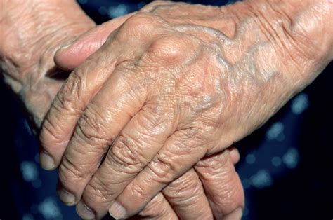 Comparing the Severity of Arthritis Types
