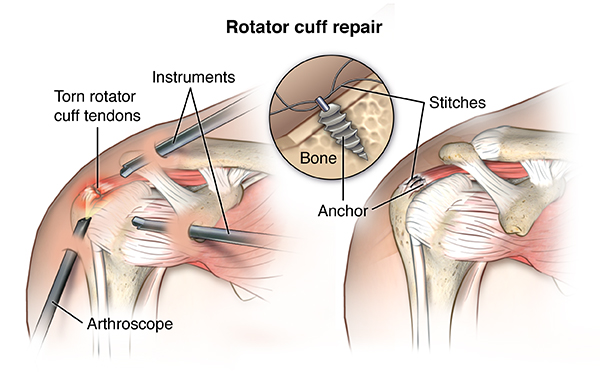 Understanding and Managing Rotator Cuff Tendinitis: Effective Home Therapies and Treatments
