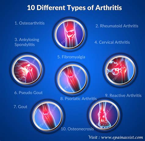 Understanding Arthritis: Types, Symptoms, and Treatment Options