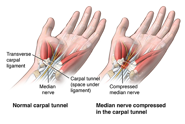 Understanding Carpal Tunnel Syndrome: Symptoms, Diagnosis, and Treatments