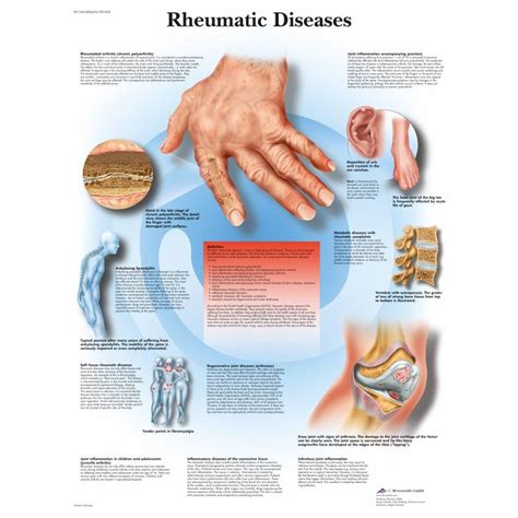 Understanding Rheumatic Diseases
