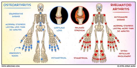 Understanding Rheumatoid Arthritis: Symptoms, Causes, and Treatment ...