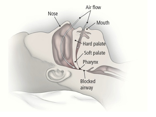 Understanding Sleep Apnea: Symptoms, Causes, and Treatments