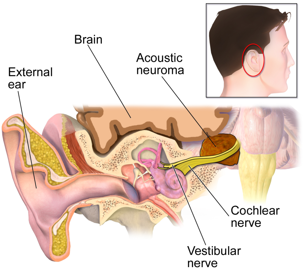 Understanding Tinnitus