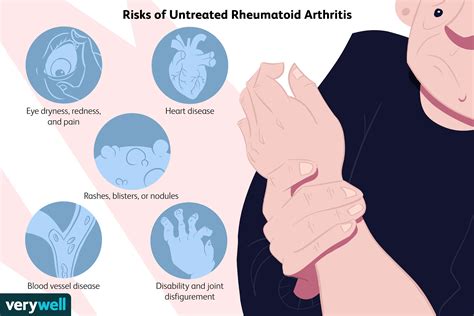 What Are the Long-Term and Short-Term Risks of Untreated Rheumatoid Arthritis?